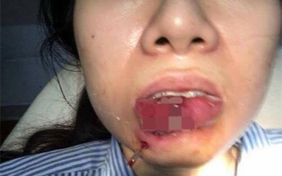 Xót xa cô gái Quảng Ninh phải cắt bỏ môi sau khi tiêm chất làm đầy