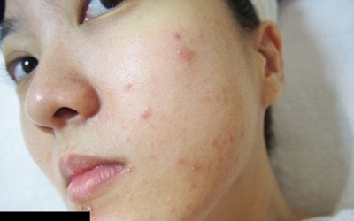 Da bị nổi mụn và ngứa do đâu?