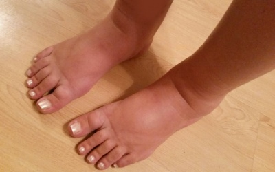 Chân bị phù trong mùa Hè phải làm sao?