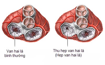 Hẹp van 2 lá có phải do di truyền? 