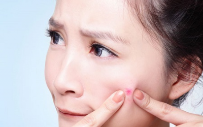 6 nguyên nhân khiến mụn trứng cá xuất hiện