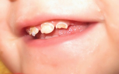 Các vấn đề về răng miệng của trẻ cha mẹ cần biết