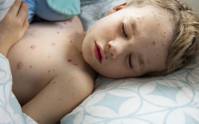 Người bị thủy đậu nên ăn uống như thế nào?