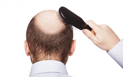 5 nguyên nhân có thể gây hói đầu ở nam giới