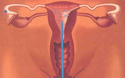 'Thả' 2 năm chưa có con, có nên thực hiện IUI?
