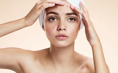 Mụn trứng cá dạng nhẹ và cách điều trị