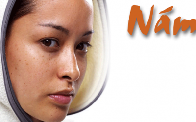 Vì sao phụ nữ 35+ hay bị nám da?