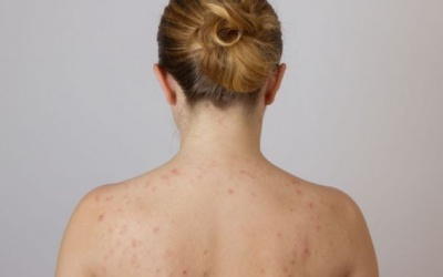 6 điều bạn nên hạn chế làm khi bị viêm nang lông