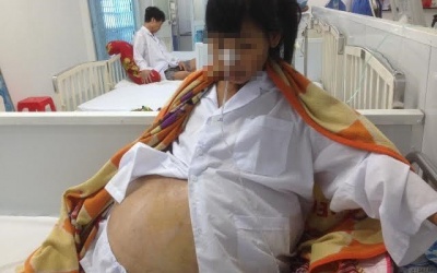 Mang khối u buồng trứng nặng 32kg vì không điều trị