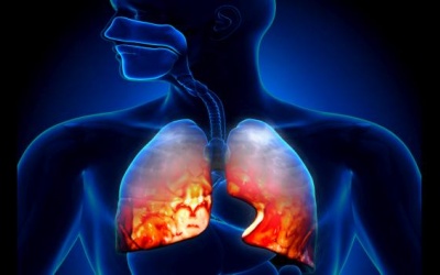 5 cách giúp ngăn ngừa bệnh viêm phổi