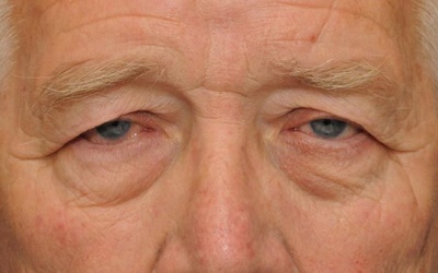 Sụp mi mắt ở người già không trị dễ mù lòa