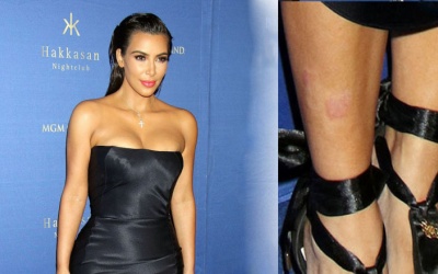 Kim Kardashian vẫn xuất hiện tự tin và xinh đẹp dù mắc vẩy nến