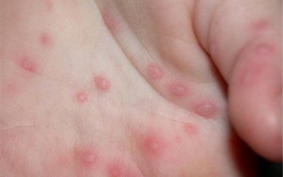 Trẻ bị sốt, mọc mụn nước do đâu?