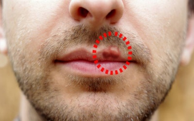 Điều trị herpes theo phương pháp cổ truyền của Ấn Độ