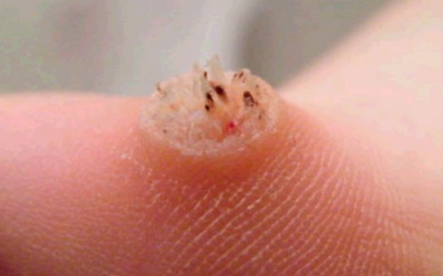 Bệnh ở chân vừa kinh vừa xấu hoành hành khi mùa mưa đang tới