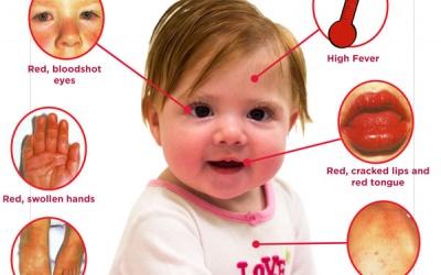 Căn bệnh lạ khó nhận biết nhưng dễ khiến trẻ tử vong