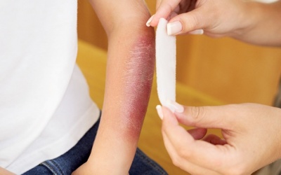 Cứ bỏng là chườm đá, xả nước lạnh: Cách sơ cứu bỏng sai lầm 