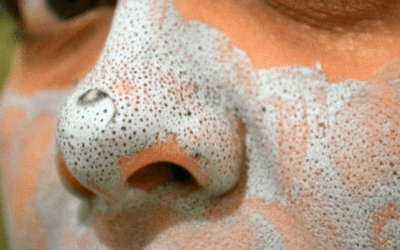 Một loạt cách trị mụn đầu đen sướng tay đã mắt