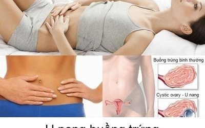 Sau phẫu thuật u nang buồng trứng, việc mang thai có bị ảnh hưởng?