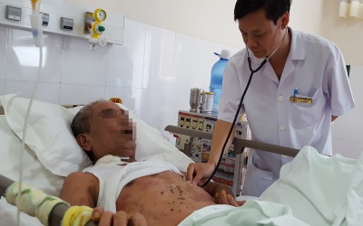 Tuột da toàn thân do dị ứng thuốc