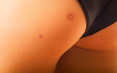  Vì sao bị mọc mụn ở mông?