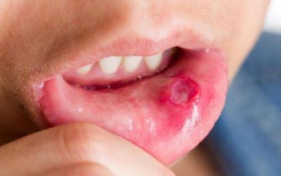 Chữa nhiệt miệng bằng nước hạt rau mùi