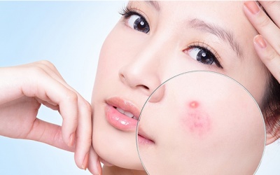 8 biện pháp thảo dược điều trị nấm ngoài da