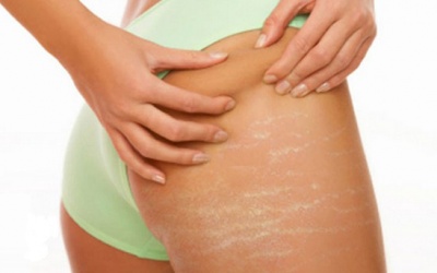 Những phương pháp để xóa sổ những vết rạn khó coi