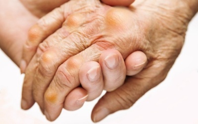 Biện pháp giảm đau khớp khi bệnh gout “hoành hành”