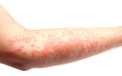 5 lý do có thể khiến cơ thể bị phát ban
