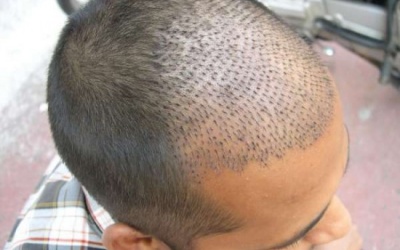 6 nguyên tắc cần biết sau khi cấy tóc