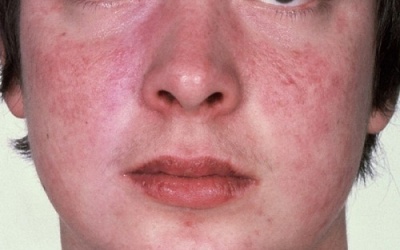 Lupus ban đỏ có gây xơ vữa động mạch?