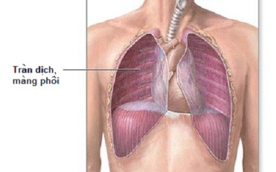 Tràn dịch màng phổi lần 2 có chữa dứt điểm được không?