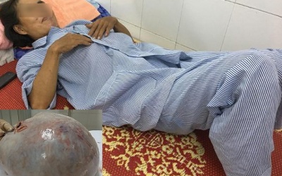 Tin lời thầy bói phán có thai, người phụ nữ mang khối u 10kg suốt 9 tháng