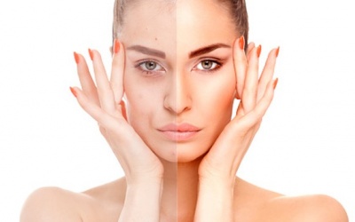 5 thói quen làm tắc nghẽn lỗ chân lông và gây ra mụn trứng cá