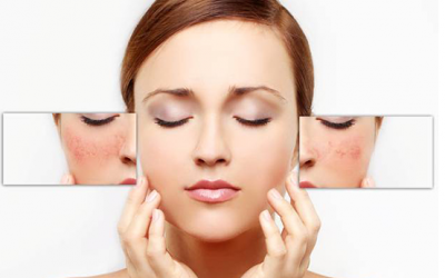 Nám da - nỗi ám ảnh dai dẳng nhưng hoàn toàn có thể xóa nhòa