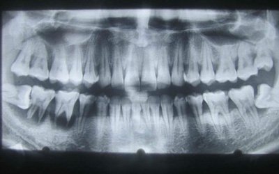 Mất mạng vì mọc răng khôn