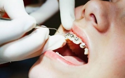 Niềng răng cho trẻ: Những điều mẹ cần biết