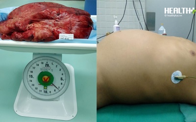 Thoát cảnh 'bụng bầu' sau khi được mổ thành công bướu khủng nặng 7kg