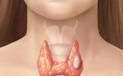 Ăn gì khi bị ung thư tuyến giáp?