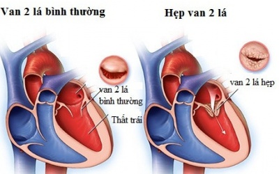 Mắc bệnh hẹp van 2 lá sinh con có nguy hiểm không?