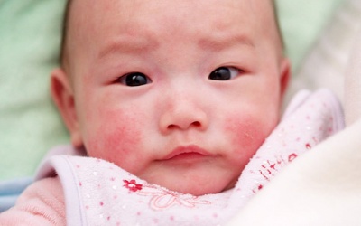 Mẹ cần lưu ý gì khi chăm sóc trẻ bị nẻ má?