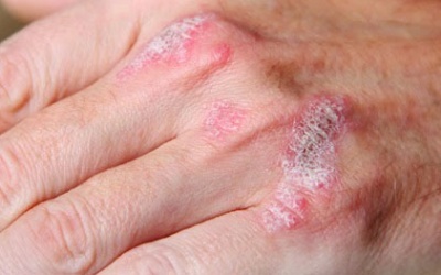 6 yếu tố môi trường làm tái phát vẩy nến