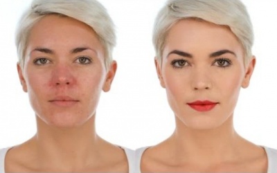 Mũi đỏ như cà chua là bệnh gì?