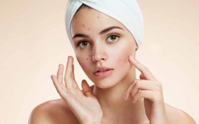 Lợi ích không ngờ của việc bị mụn trứng cá