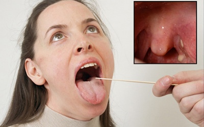 Bị viêm amidan hốc mủ có nên dùng Tiêu Khiết Thanh?