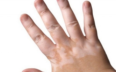 Điều trị bạch biến như thế nào?