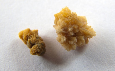 Những nguyên nhân làm tăng nguy cơ sỏi thận