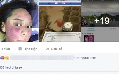 Mặt xuất huyết tím đen vì dùng kem trị mụn mua qua facebook