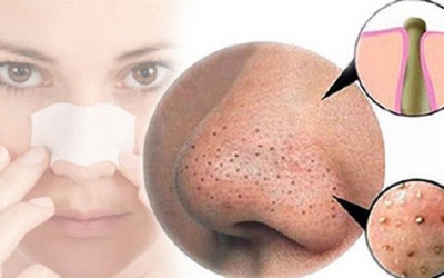 Làm thế nào để hạn chế mụn đầu đen?